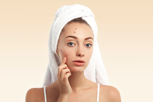 Blemishes: Causes, types, and treatments