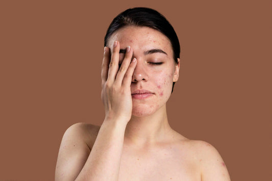 Home remedies to treat skin pigmentation