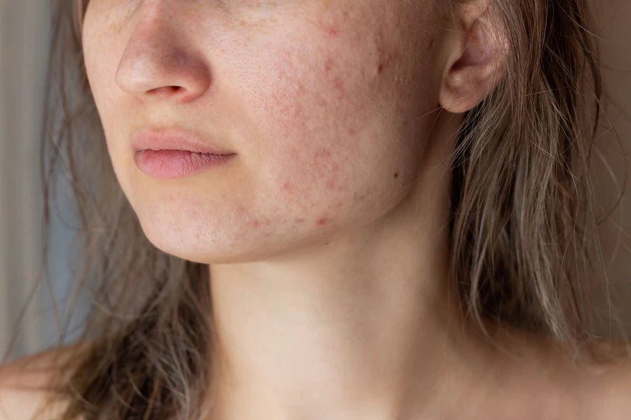 Top 3 Serum to Remove Melasma