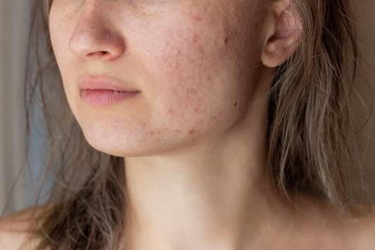 Top 3 Serum to Remove Melasma
