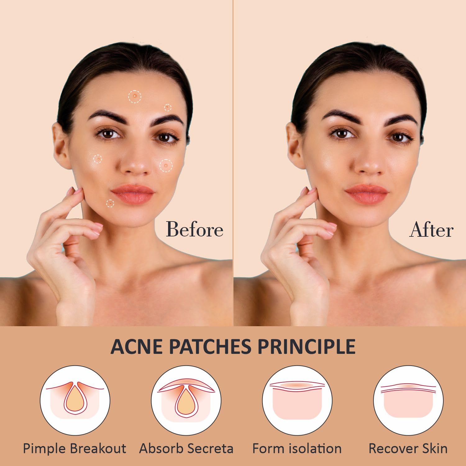 Rejusure Acne Patch | Waterproof Patches | Absorbs Pimple Overnight, Reduces Excess Oil | Acne Korean Spot Patch for Covering Zits and Blemishes | For All Skin Types | Men & Women (Pack of 1)